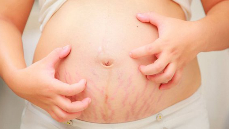 14 Sự thật và hư cấu về rạn da khi mang thai