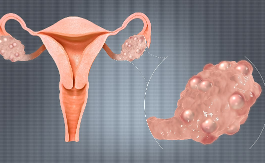 Hội chứng buồng trứng đa nang (PCOS) ở nữ thanh thiếu niên và phụ nữ